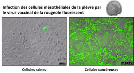 Infection des cellules mésothéliales de la plèvre par le virus vaccinal de la rougeole.